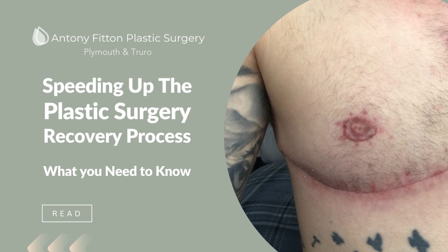 How do I speed up the plastic surgery recovery process?