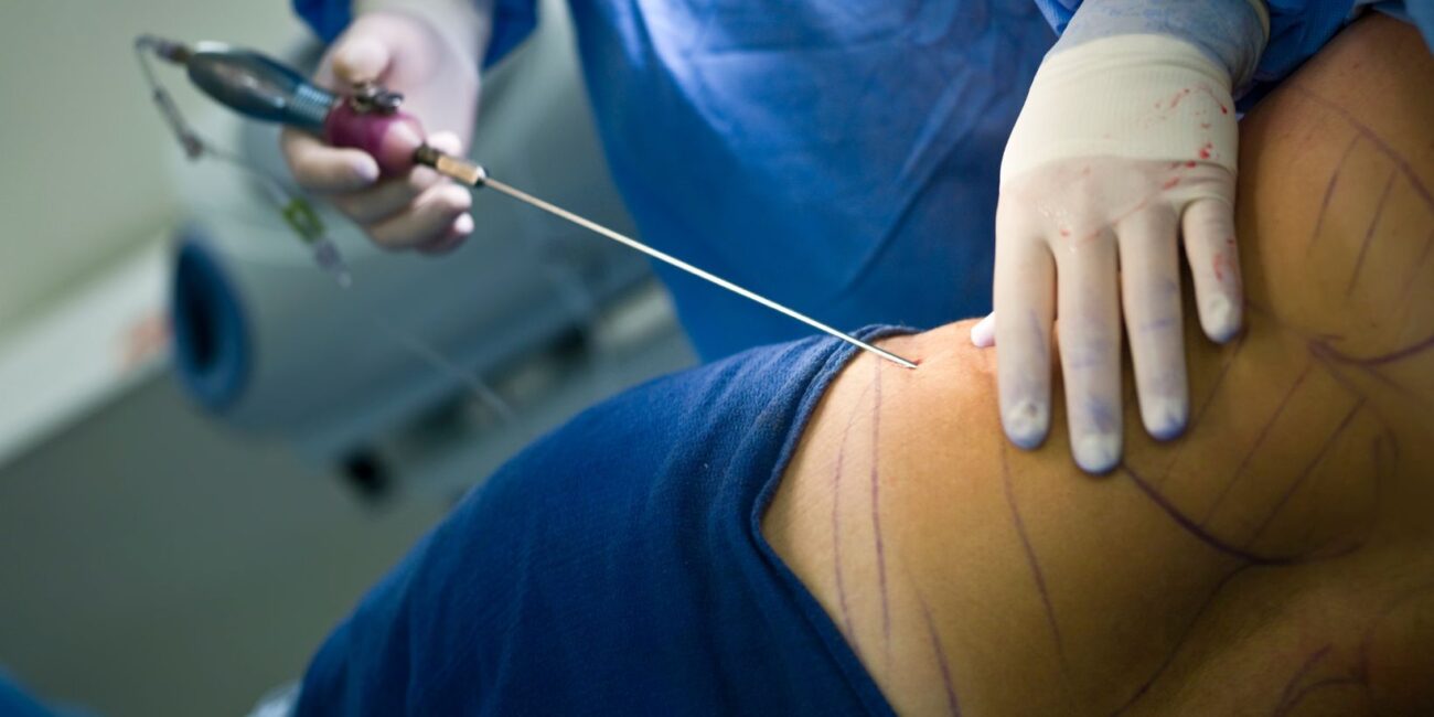 How Long Does Liposuction Last (2)