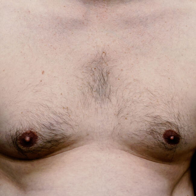 Is Male Chest Reduction Right for Me? Key Questions Answered | Antony Fitton Plastic Surgery | Plymouth & Truro