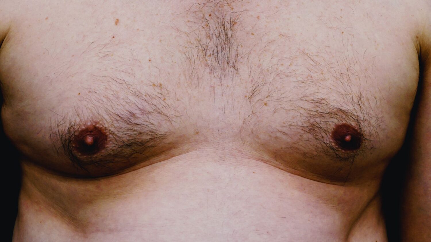 Is Male Chest Reduction Right for Me? Key Questions Answered | Antony Fitton Plastic Surgery | Plymouth & Truro