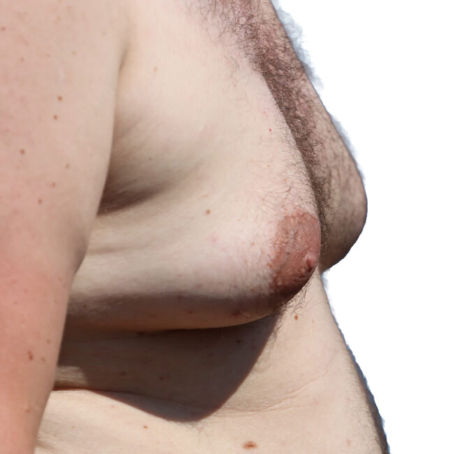 Is Male Chest Reduction Right for Me? Key Questions Answered | Antony Fitton Plastic Surgery | Plymouth & Truro