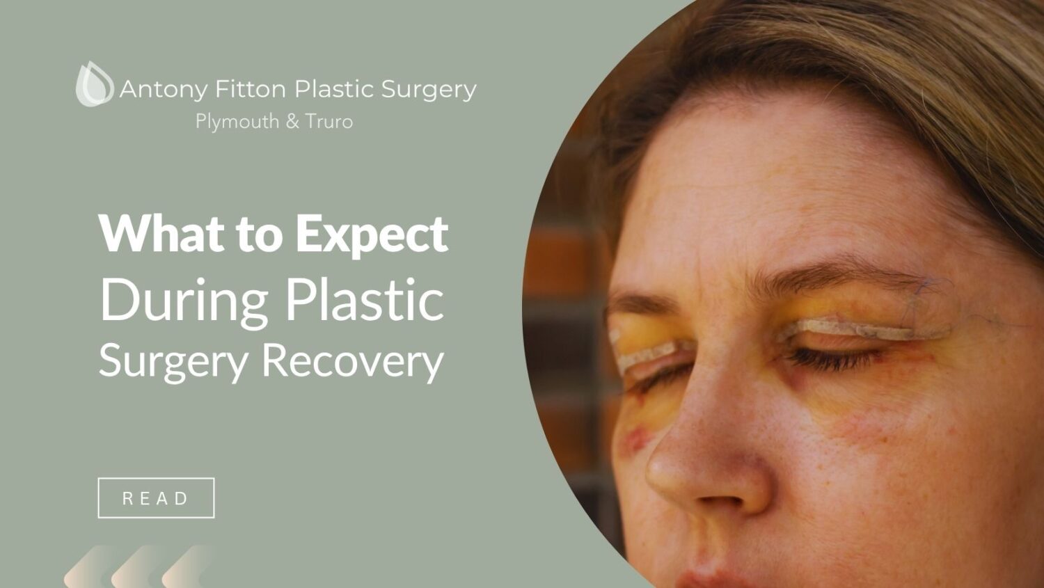 This guide gives you a clear idea of what plastic surgery recovery looks like | Antony Fitton Plastic Surgery | Plymouth & Truro