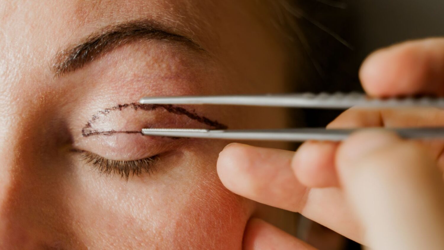 What are the different types of eyelid reduction surgery? And is it safe? | Antony Fitton Plastic Surgery | Plymouth & Truro