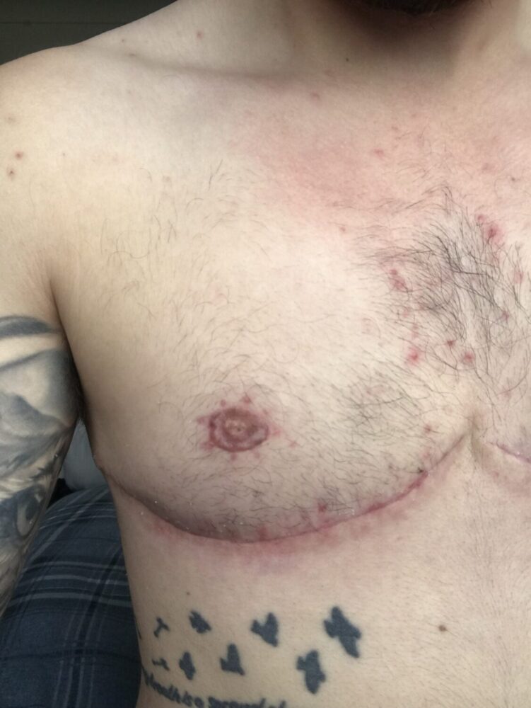 Am I a Suitable Candidate for FTM Top Surgery?